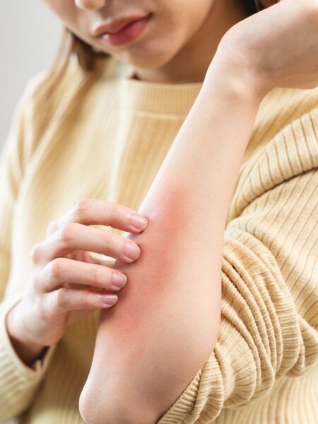 Nadwrażliwa skóra: Młoda kobieta drapie się po ramieniu i ma czerwoną wysypkę na skórze, która jest wynikiem nietolerancji kurzu.