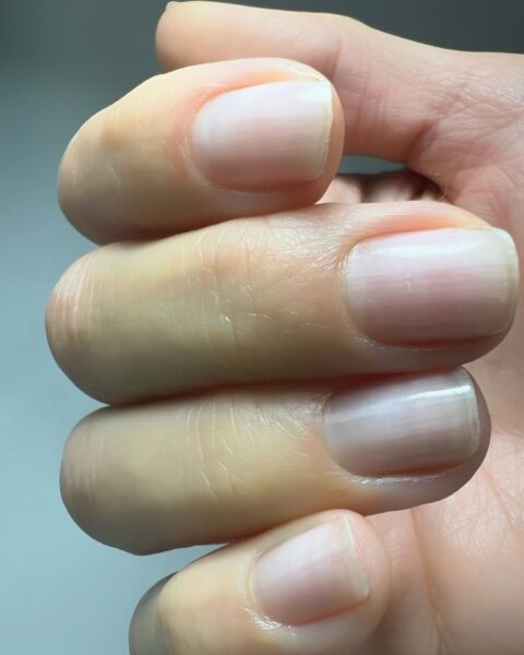 Ozempikowe paznokcie – zdradzają, czy odchudzałaś się kontrowersyjnym lekiem