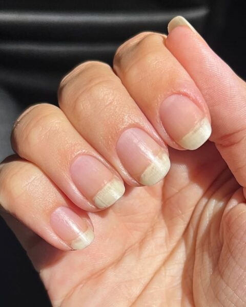 Zdjęcie przedstawia dłoń z naturalnymi paznokciami, u których widoczna jest dystalna onycholiza – oddzielenie płytki paznokcia od łożyska, szczególnie zauważalne na dłuższych, jaśniejszych końcówkach. Ta kondycja paznokci często jest sygnałem niedoborów, urazów lub problemów zdrowotnych, a jej prawidłowa identyfikacja jest kluczowa dla skutecznej pielęgnacji i leczenia.